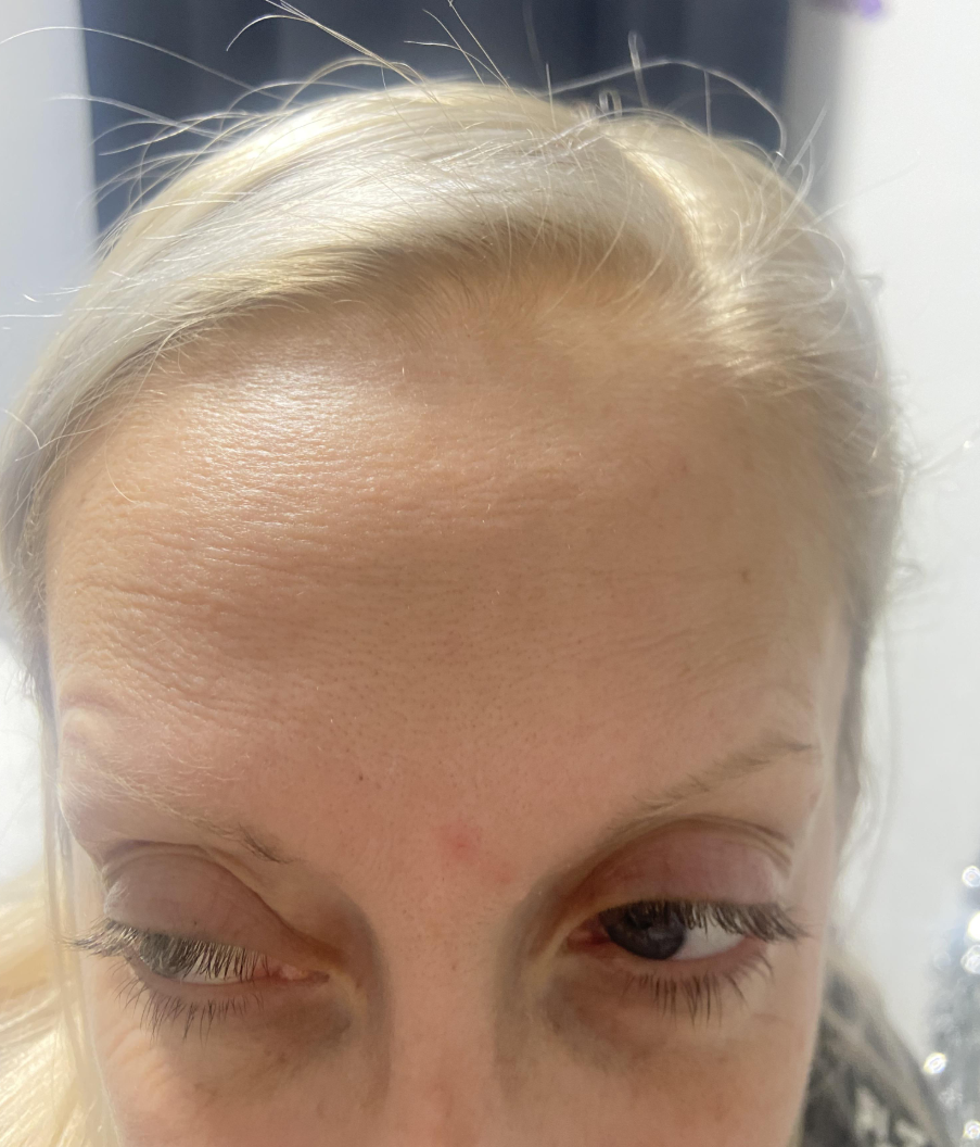 After — Anti-wrinkle treatment
