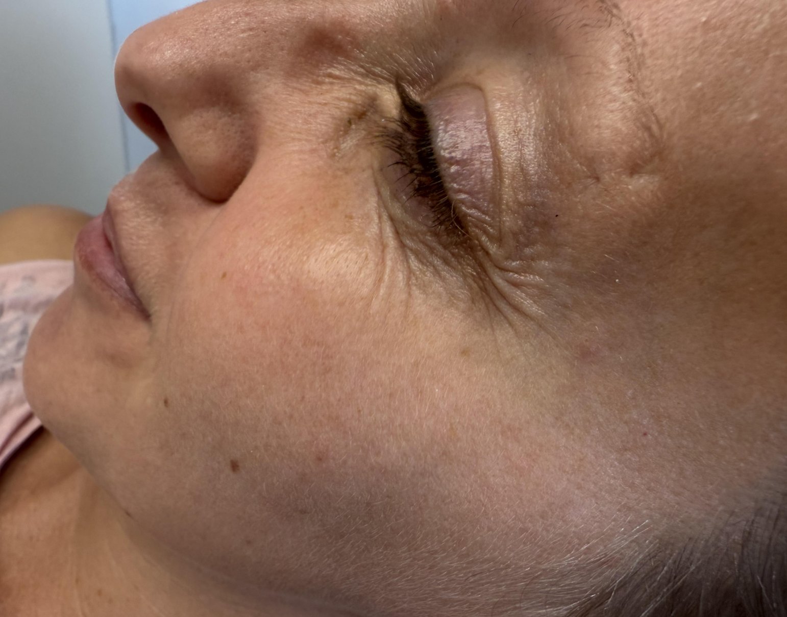 After — Crow's feet — anti-wrinkle injections