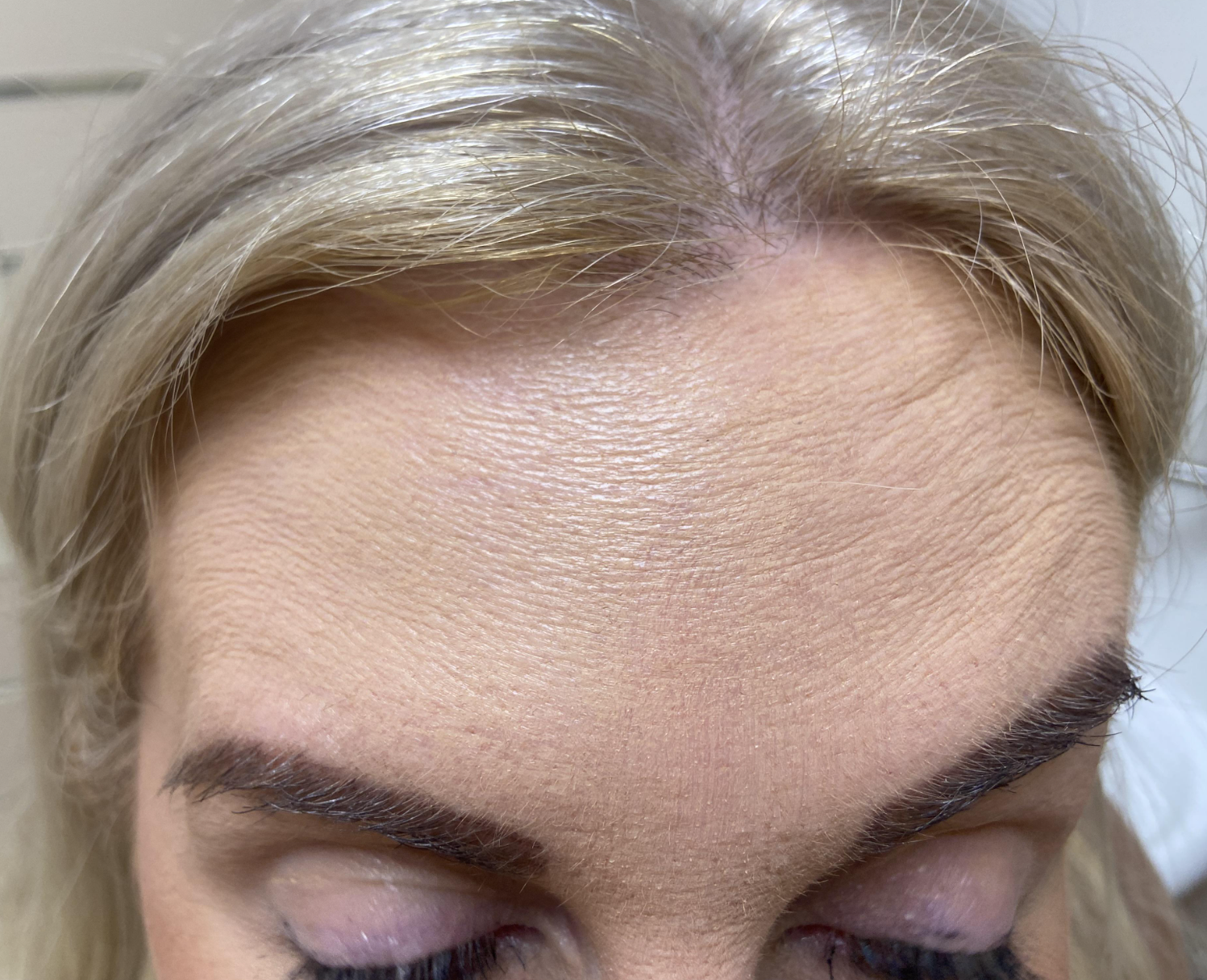 After anti-wrinkle treatment — smoother forehead