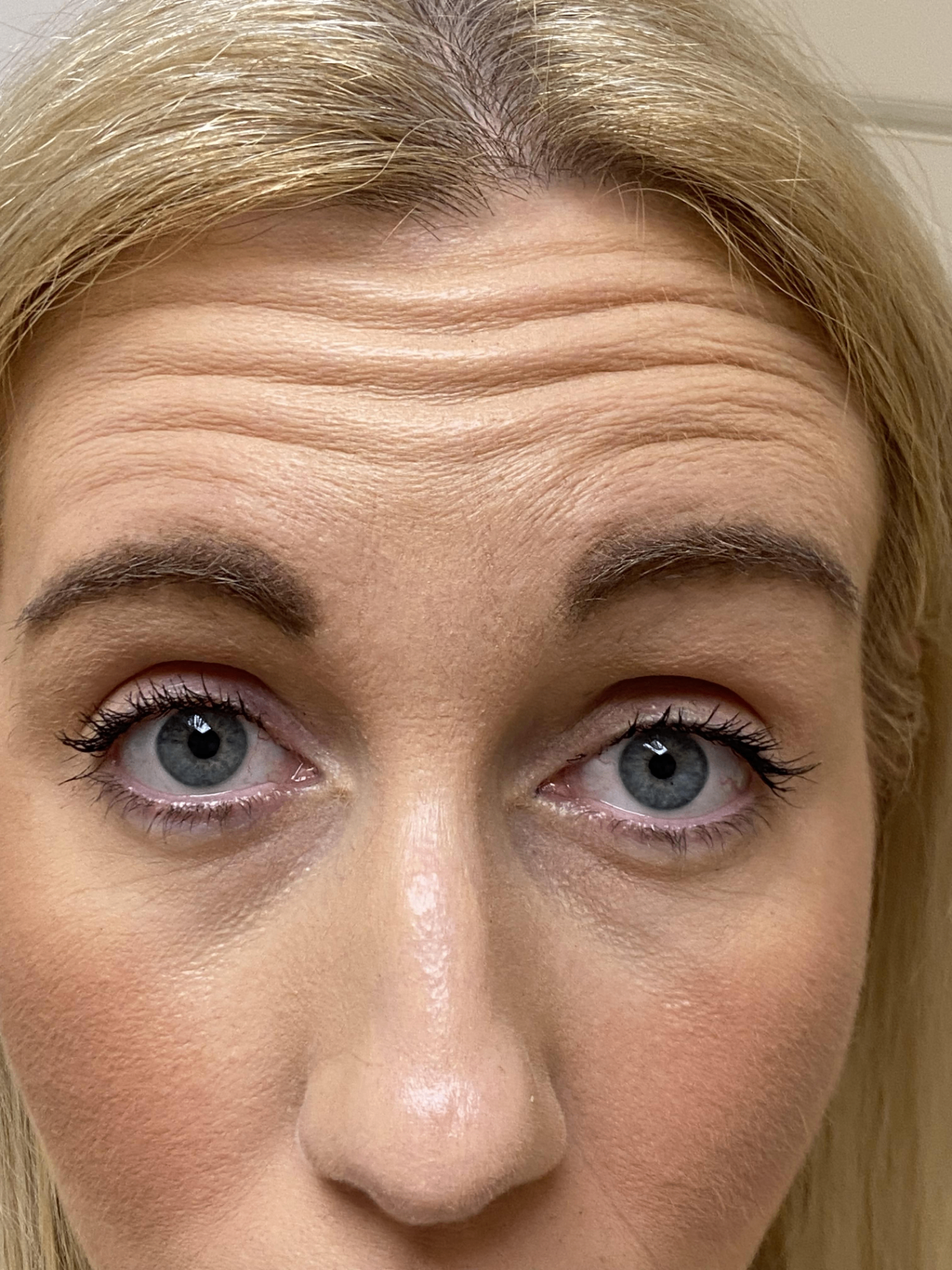 Before anti-wrinkle treatment — forehead lines