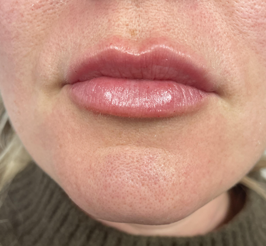 After lip filler treatment