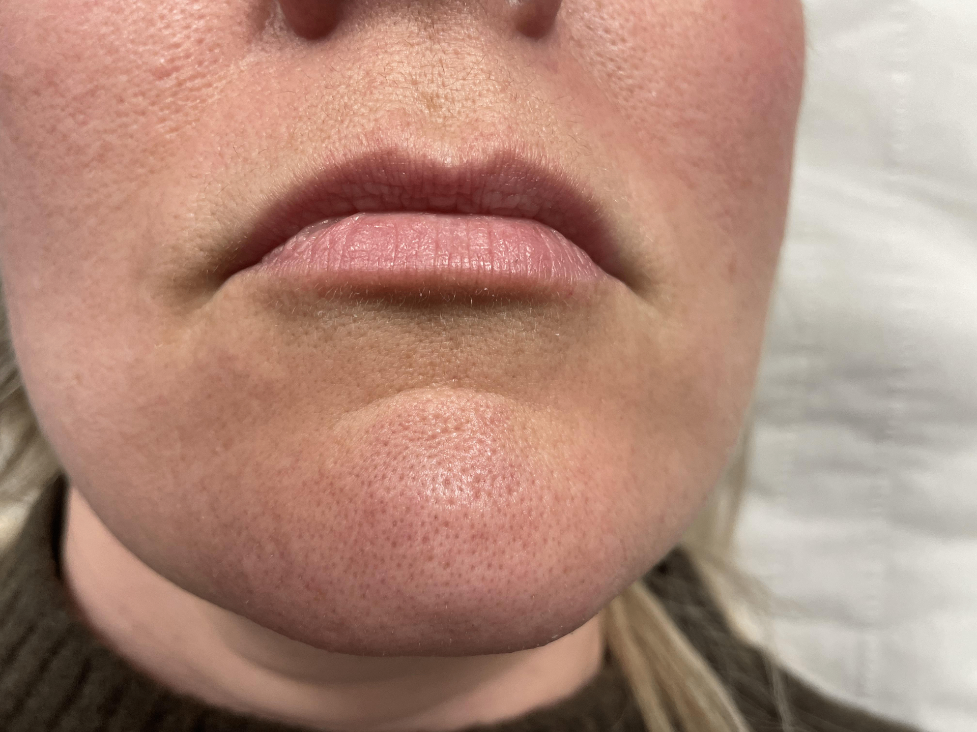 Before lip filler treatment