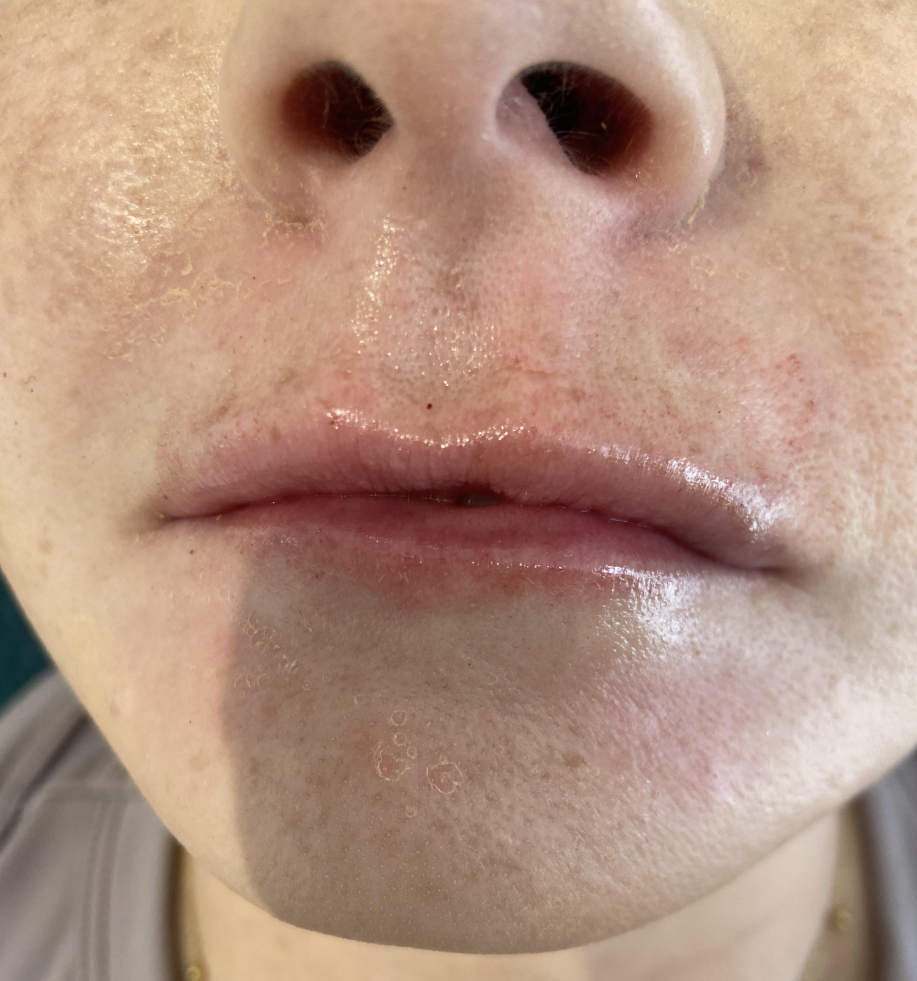 After lip filler treatment
