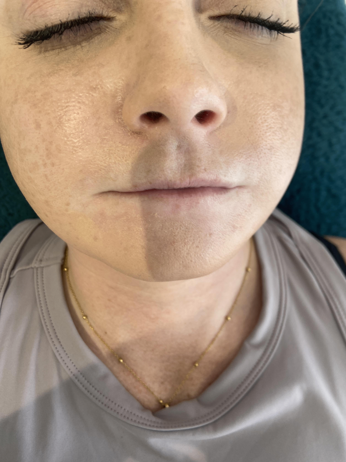 Before lip filler treatment